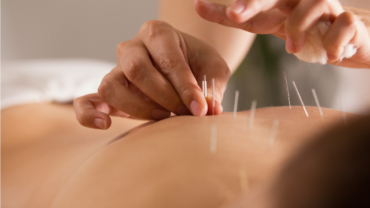 Acupuncture and Its Potential Role in Mainstream Care